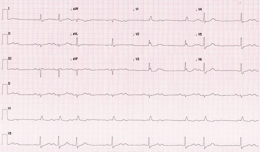 EKG spori ritam srca